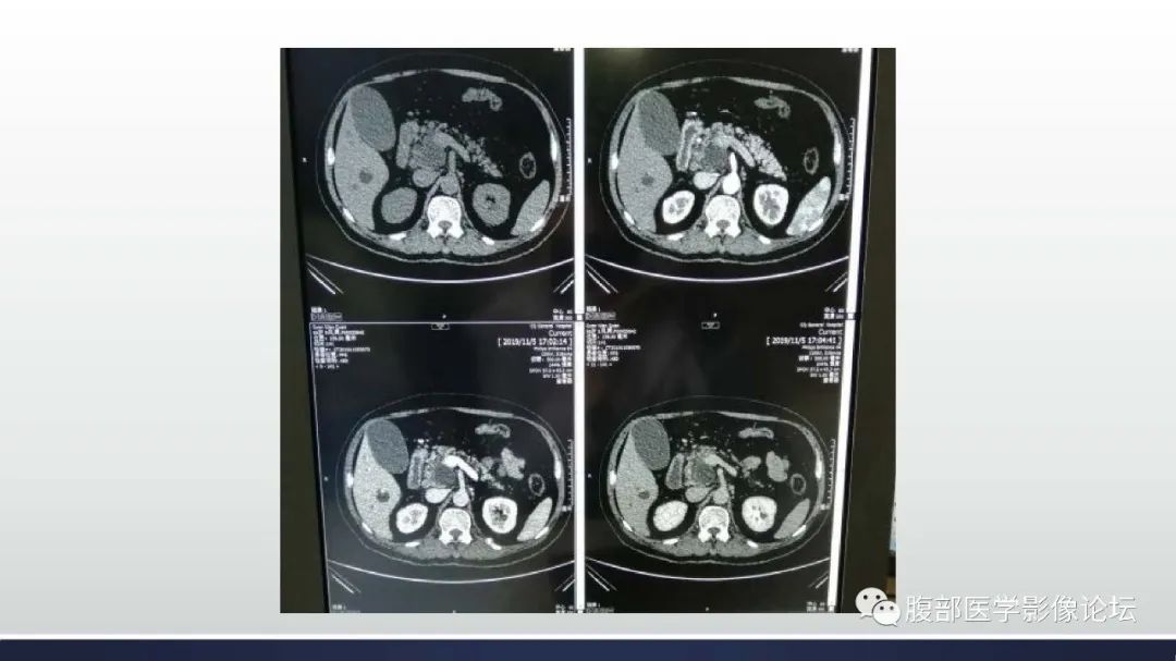 【病例】胰腺癌1例CT影像