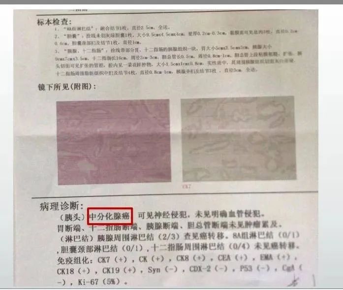 【病例】胰腺癌1例CT影像