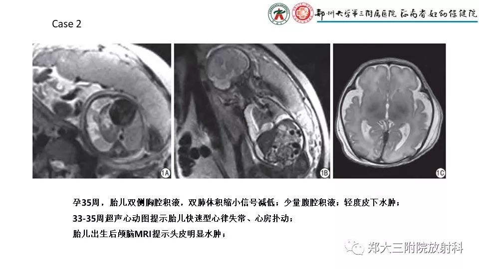 【PPT】胎儿水肿综合征