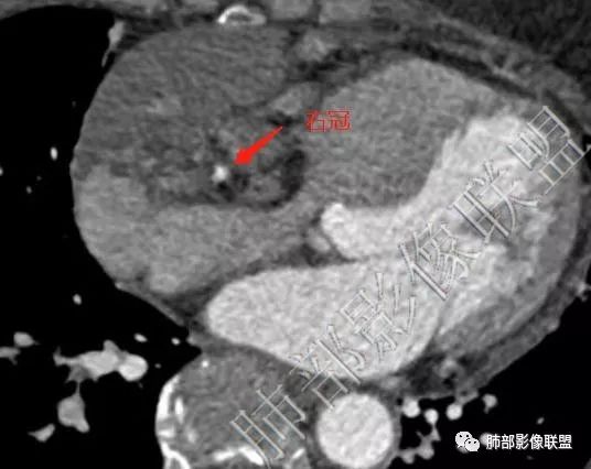 【病例】心包海绵状血管瘤1例CT影像