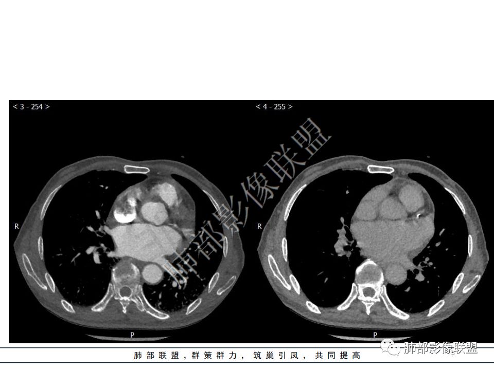 【病例】心脏血管肉瘤1例CT影像
