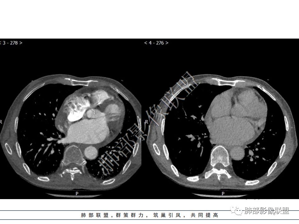 【病例】心脏血管肉瘤1例CT影像