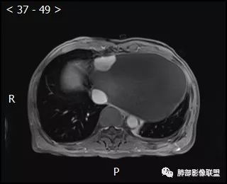 【病例】心包恶性间皮瘤1例CT影像