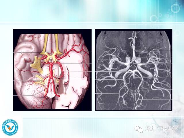 【PPT】颅内动脉供血区域解剖及临床影像