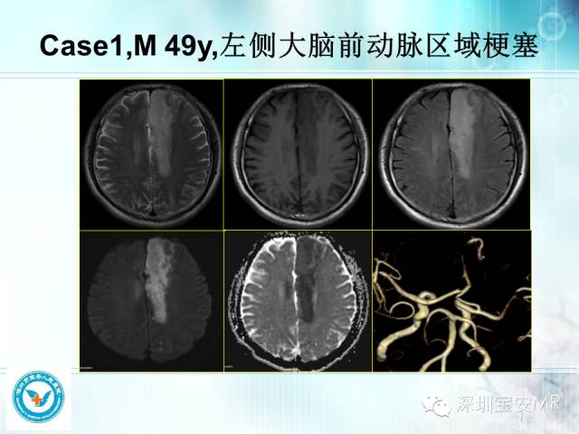 【PPT】颅内动脉供血区域解剖及临床影像