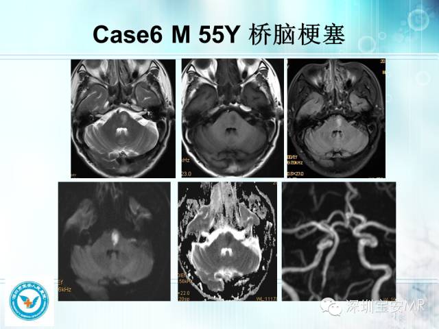 【PPT】颅内动脉供血区域解剖及临床影像