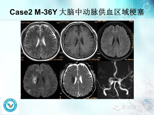 【PPT】颅内动脉供血区域解剖及临床影像