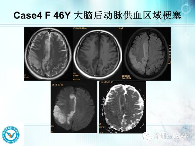 【PPT】颅内动脉供血区域解剖及临床影像