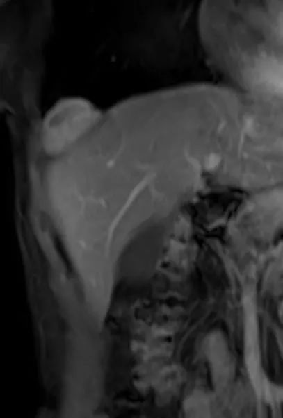 胸膜解剖及胸膜孤立性纤维瘤的 CT 诊断