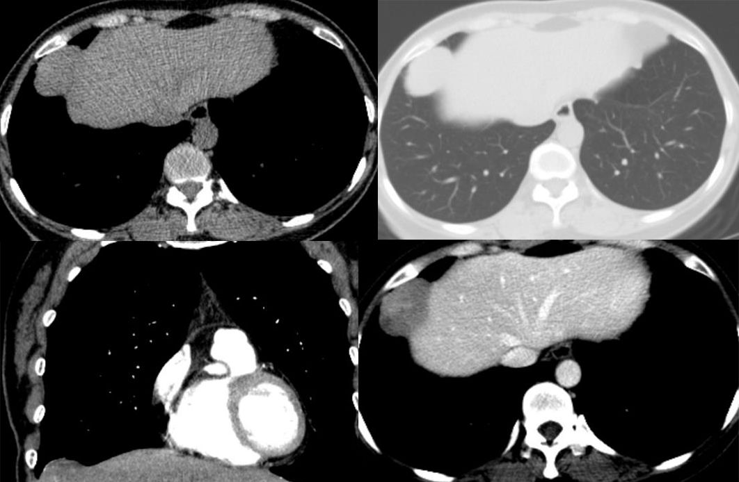 胸膜解剖及胸膜孤立性纤维瘤的 CT 诊断