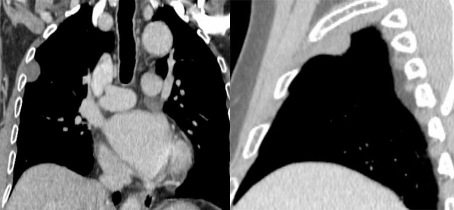 胸膜解剖及胸膜孤立性纤维瘤的 CT 诊断 胸膜解剖及胸膜孤立性纤维瘤的 CT 诊断