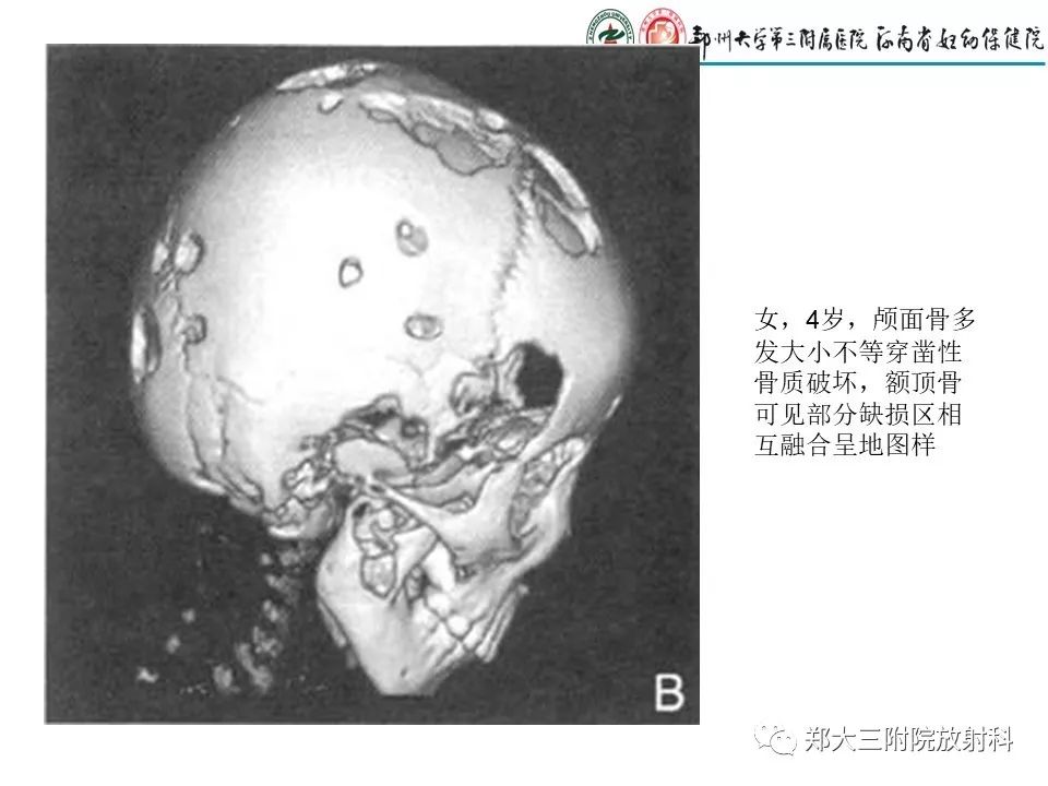 【PPT】儿童朗格汉斯细胞增生症的影像学表现