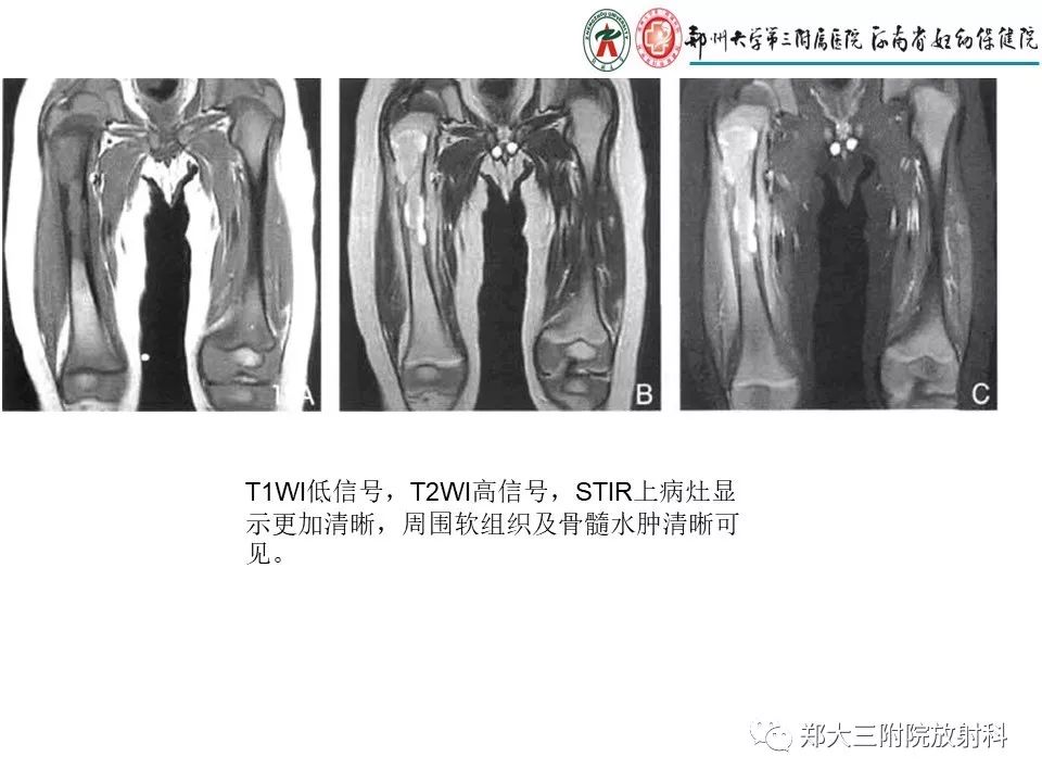 【PPT】儿童朗格汉斯细胞增生症的影像学表现