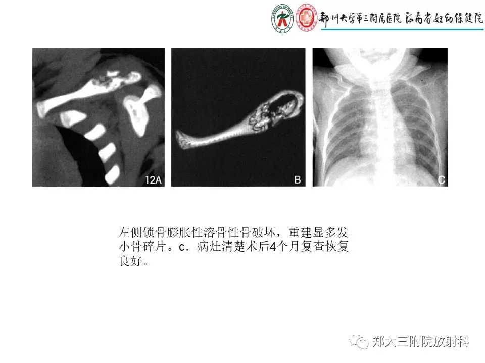 【PPT】儿童朗格汉斯细胞增生症的影像学表现