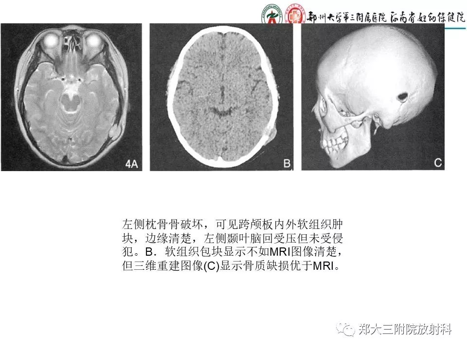 【PPT】儿童朗格汉斯细胞增生症的影像学表现