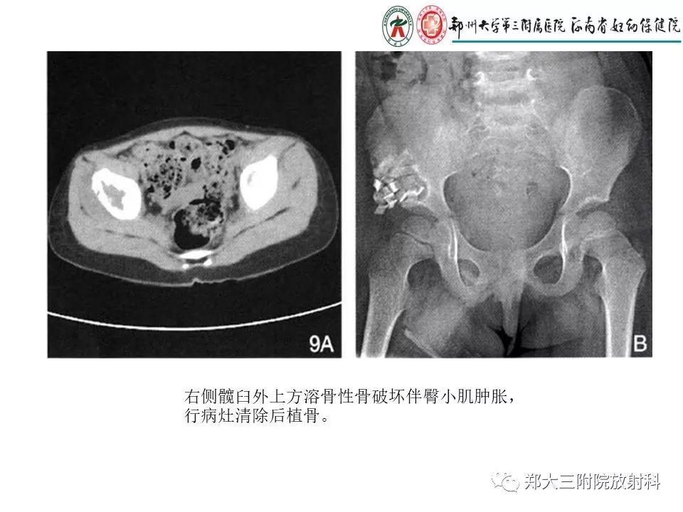 【PPT】儿童朗格汉斯细胞增生症的影像学表现