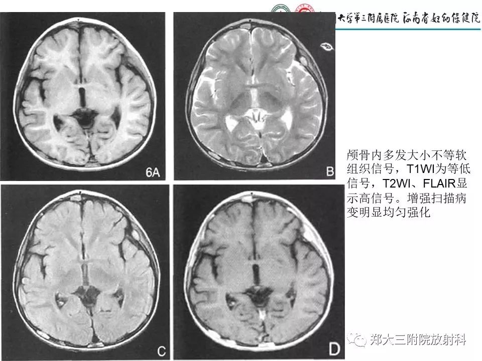 【PPT】儿童朗格汉斯细胞增生症的影像学表现