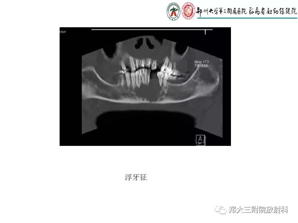 【PPT】儿童朗格汉斯细胞增生症的影像学表现