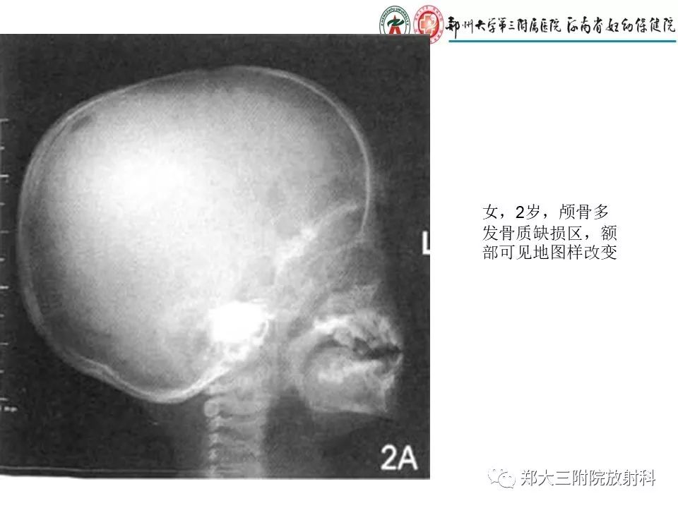 【PPT】儿童朗格汉斯细胞增生症的影像学表现