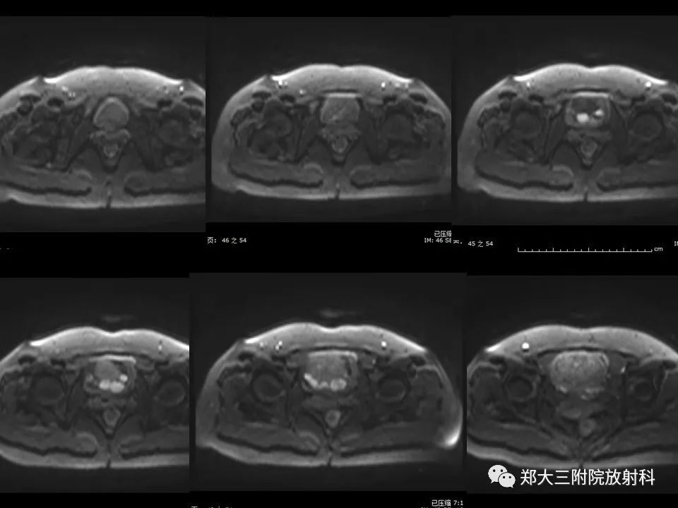 【病例】一例有内膜癌的子宫腺肌症MR