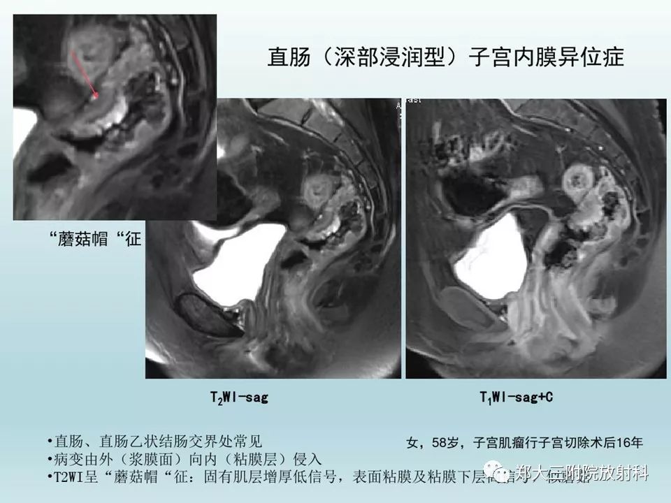 【病例】一例有内膜癌的子宫腺肌症MR