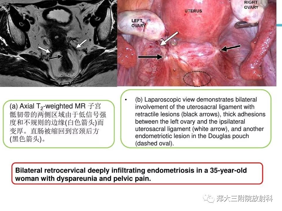 【病例】一例有内膜癌的子宫腺肌症MR