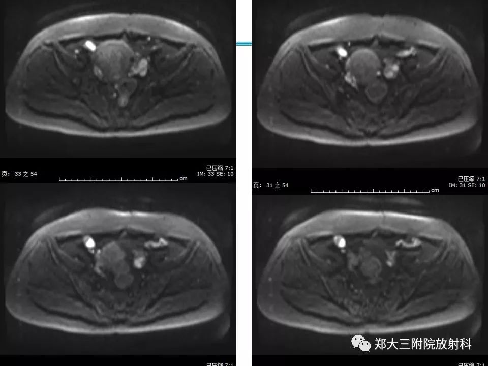 【病例】一例有内膜癌的子宫腺肌症MR