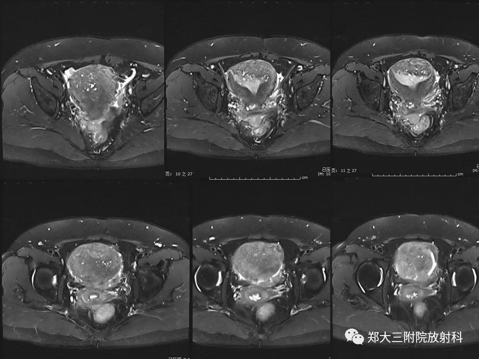 【病例】一例有内膜癌的子宫腺肌症MR
