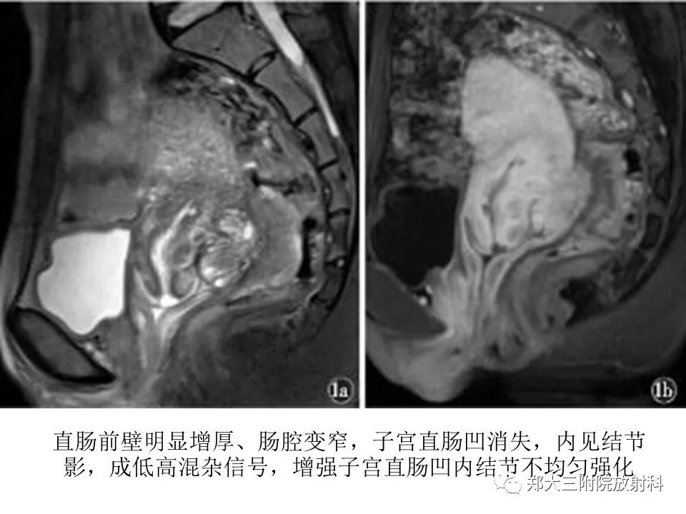 【病例】一例有内膜癌的子宫腺肌症MR