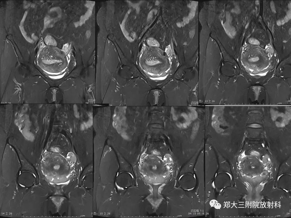 【病例】一例有内膜癌的子宫腺肌症MR