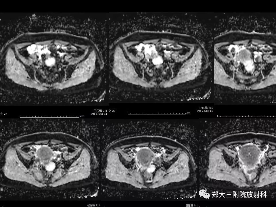 【病例】一例有内膜癌的子宫腺肌症MR