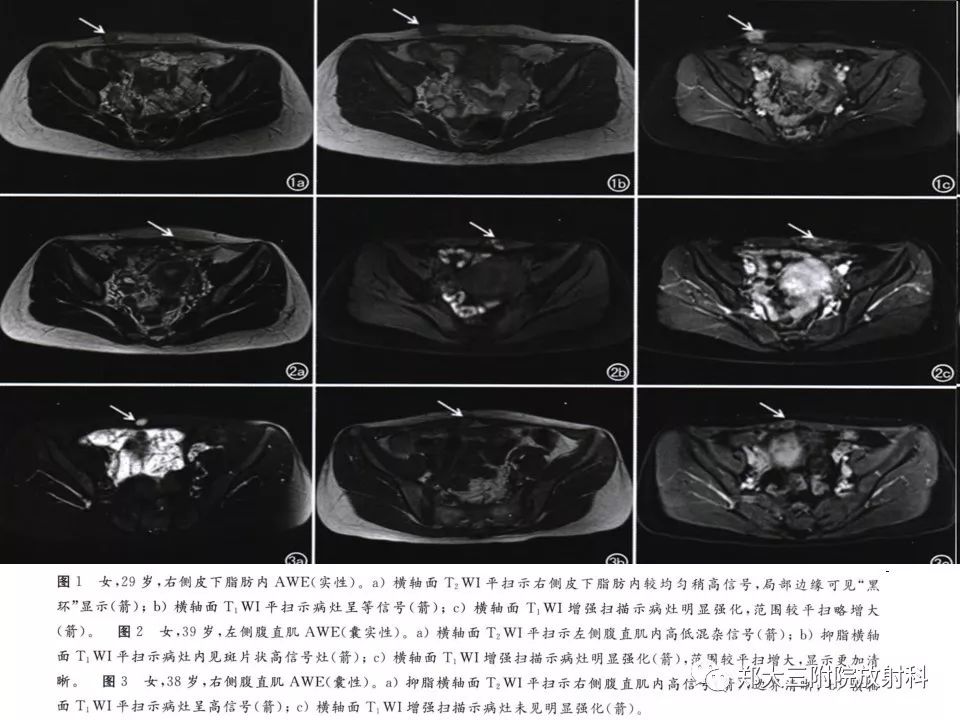 【病例】一例有内膜癌的子宫腺肌症MR