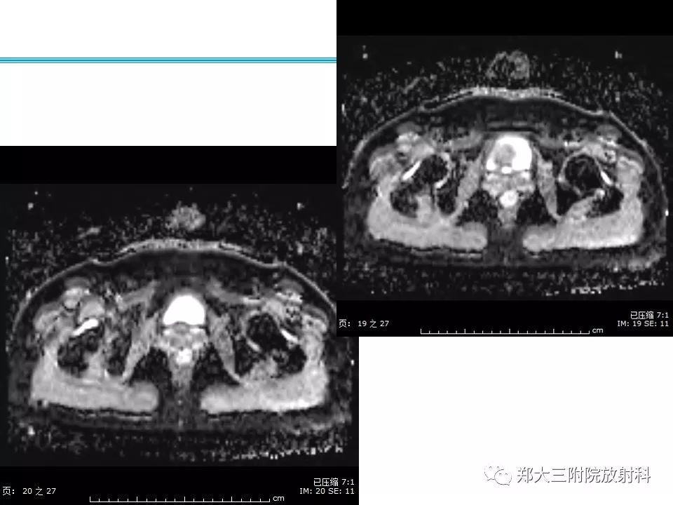 【病例】一例有内膜癌的子宫腺肌症MR