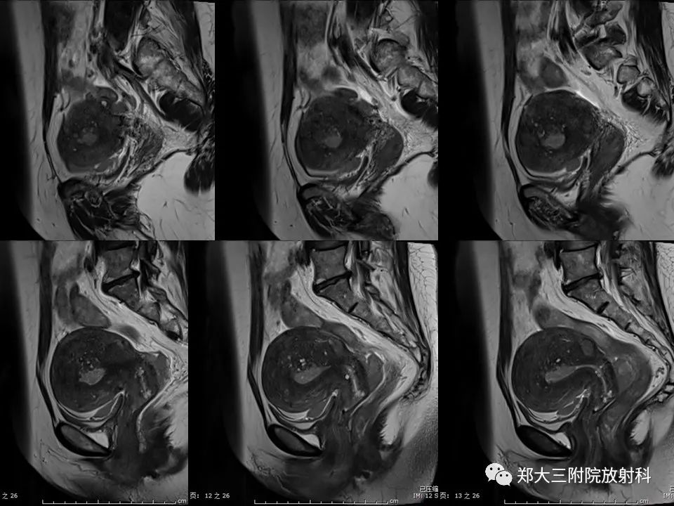 【病例】一例有内膜癌的子宫腺肌症MR