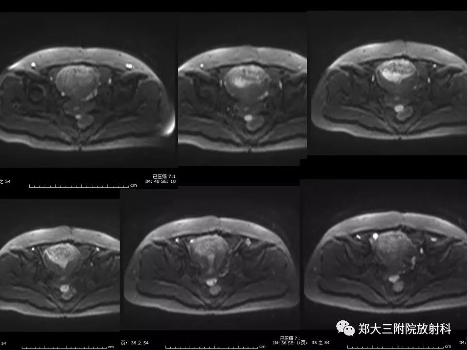 【病例】一例有内膜癌的子宫腺肌症MR