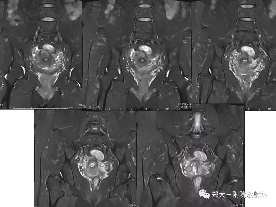 【病例】一例有内膜癌的子宫腺肌症MR