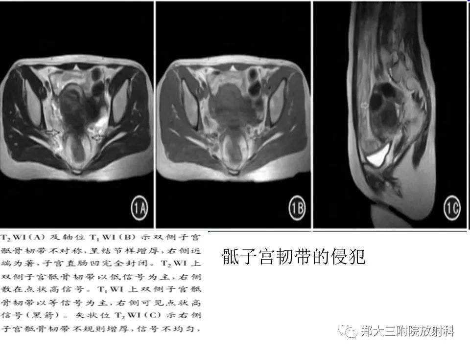 【病例】一例有内膜癌的子宫腺肌症MR