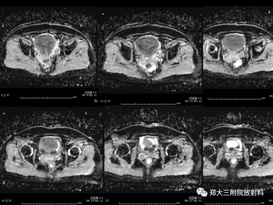 【病例】一例有内膜癌的子宫腺肌症MR