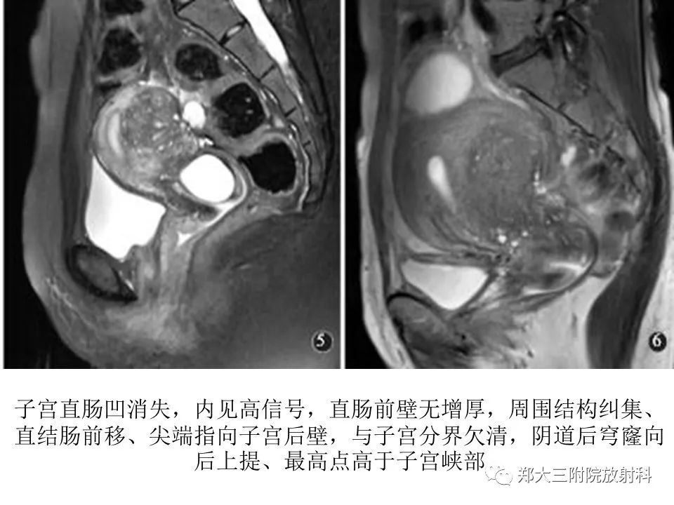 【病例】一例有内膜癌的子宫腺肌症MR