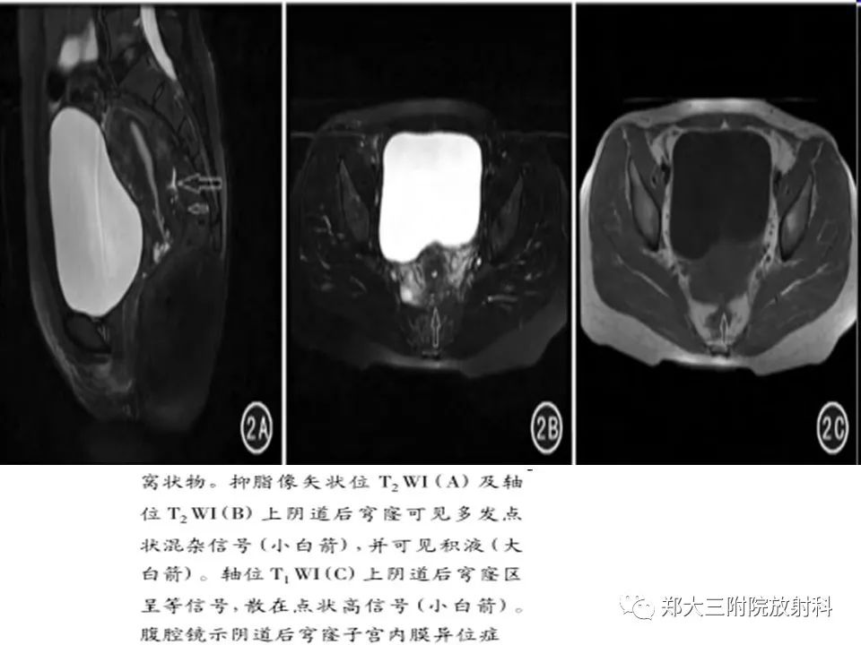 【病例】一例有内膜癌的子宫腺肌症MR