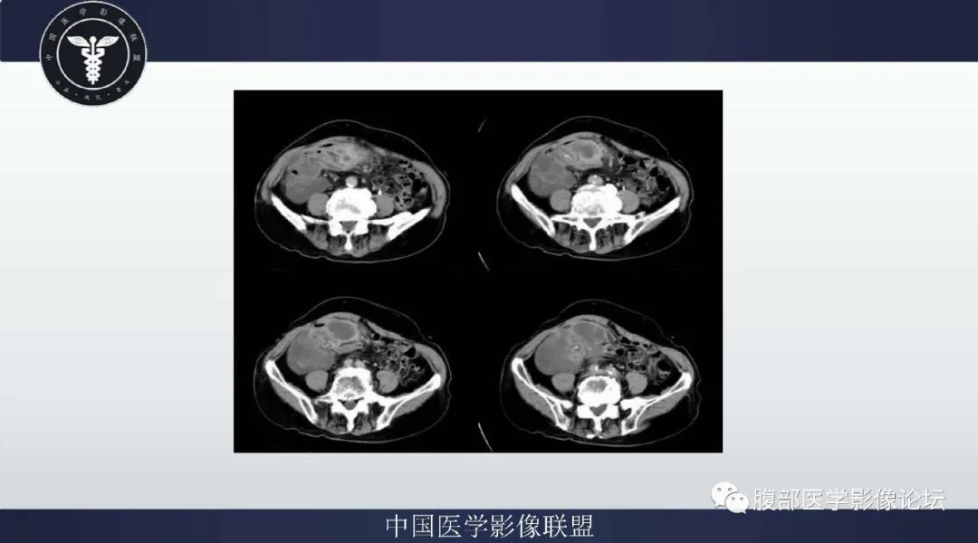 【病例】阑尾黏液腺癌1例CT及MR影像