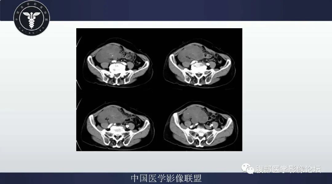 【病例】阑尾黏液腺癌1例CT及MR影像