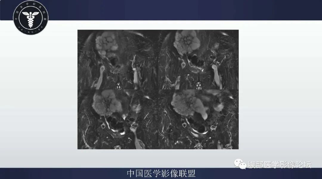 【病例】阑尾黏液腺癌1例CT及MR影像