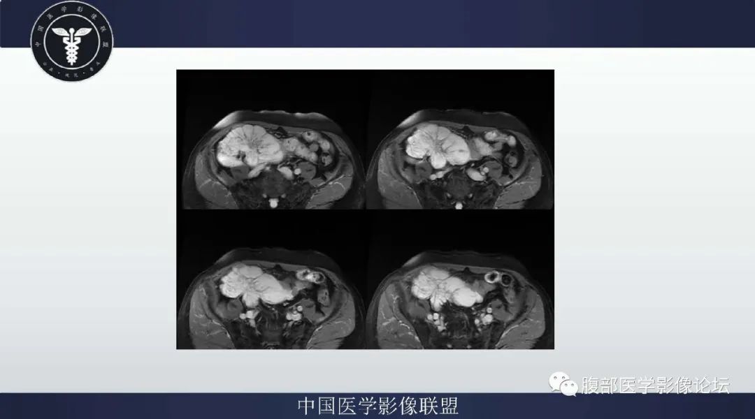 【病例】阑尾黏液腺癌1例CT及MR影像
