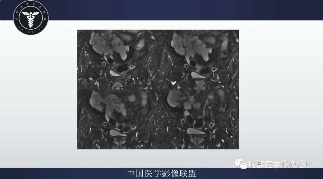 【病例】阑尾黏液腺癌1例CT及MR影像