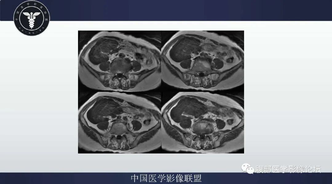 【病例】阑尾黏液腺癌1例CT及MR影像