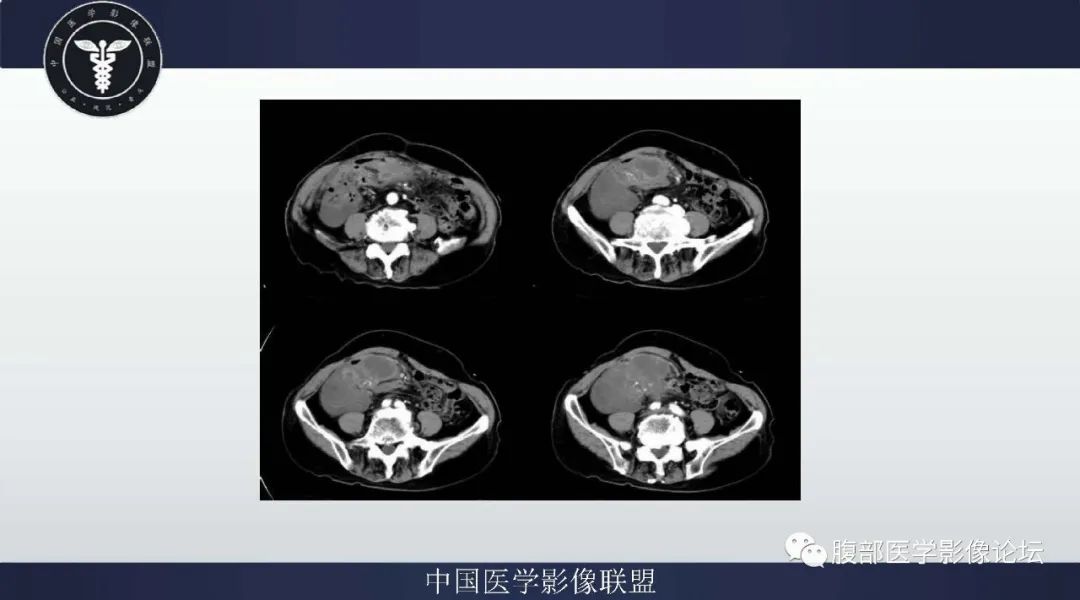 【病例】阑尾黏液腺癌1例CT及MR影像