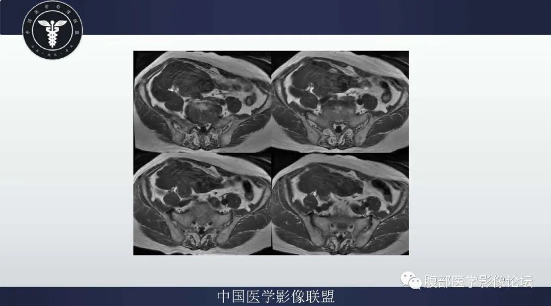 【病例】阑尾黏液腺癌1例CT及MR影像