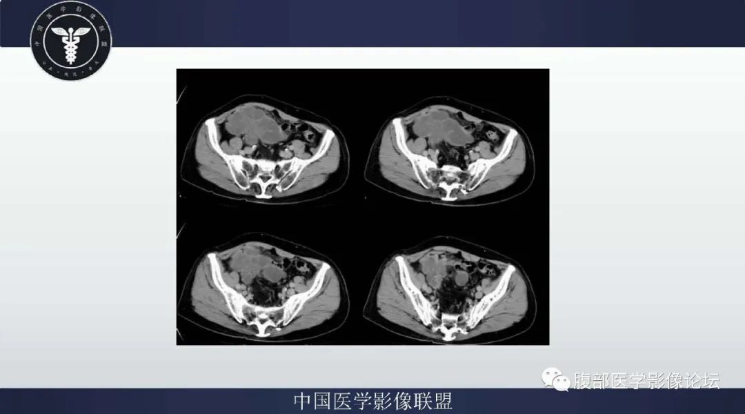 【病例】阑尾黏液腺癌1例CT及MR影像
