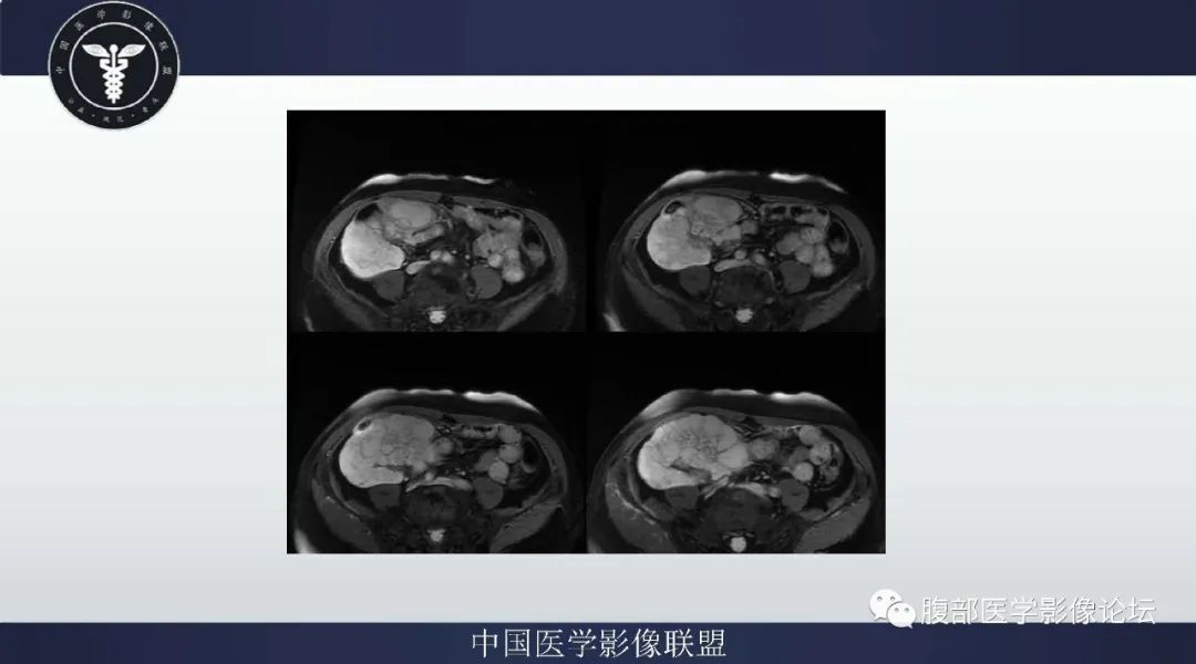 【病例】阑尾黏液腺癌1例CT及MR影像